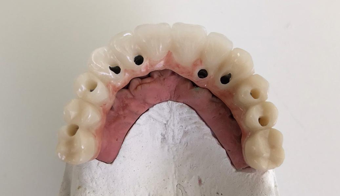 Branemarkův můstek s pryskyřičnými zuby