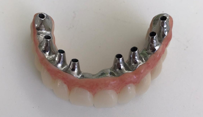 Branemarkův můstek se zirkonovými zuby