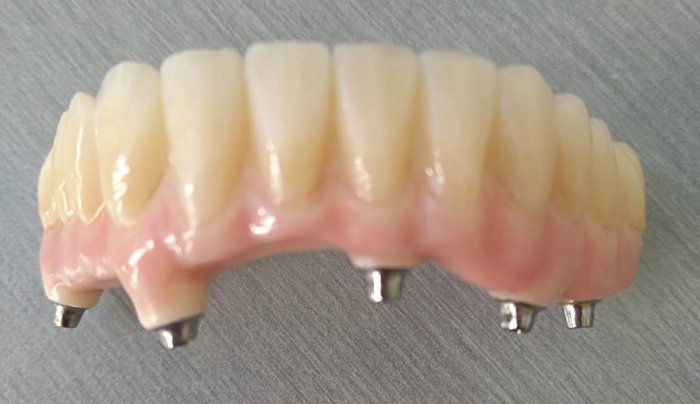 Branemarkův můstek se zirkonovými zuby