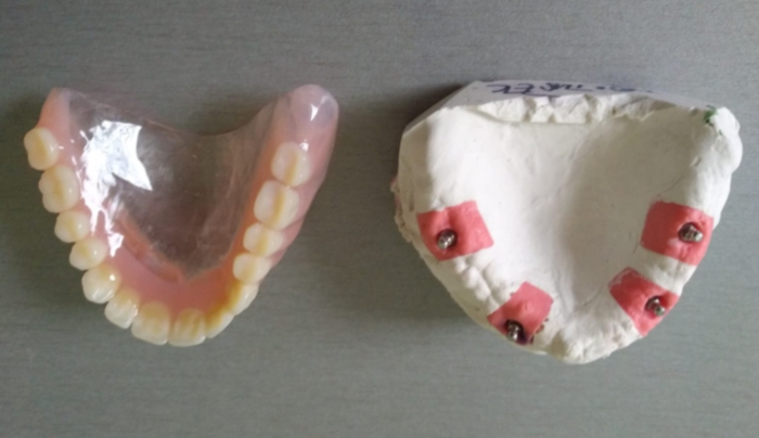 Celkové hybridní náhrady s otvory pro upevnění v dutině ústní pomocí dentálních implantátů