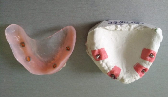 Celkové hybridní náhrady s otvory pro upevnění v dutině ústní pomocí dentálních implantátů