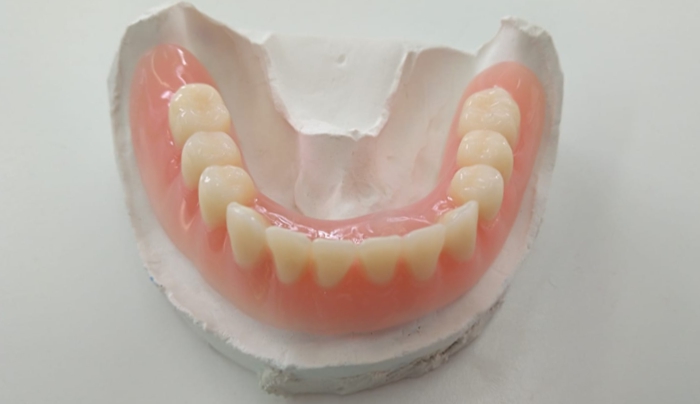 Celkové hybridní náhrady s otvory pro upevnění v dutině ústní pomocí dentálních implantátů