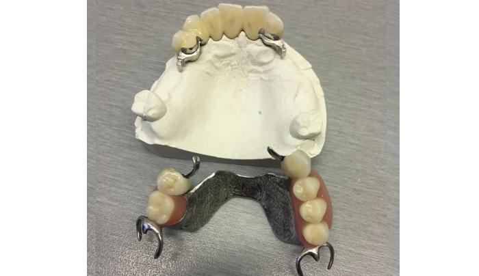 metalokeramický můstek se zásuvnými spoji a částečná náhrada horní s litou patrovou deskou a zásuvnými spoji