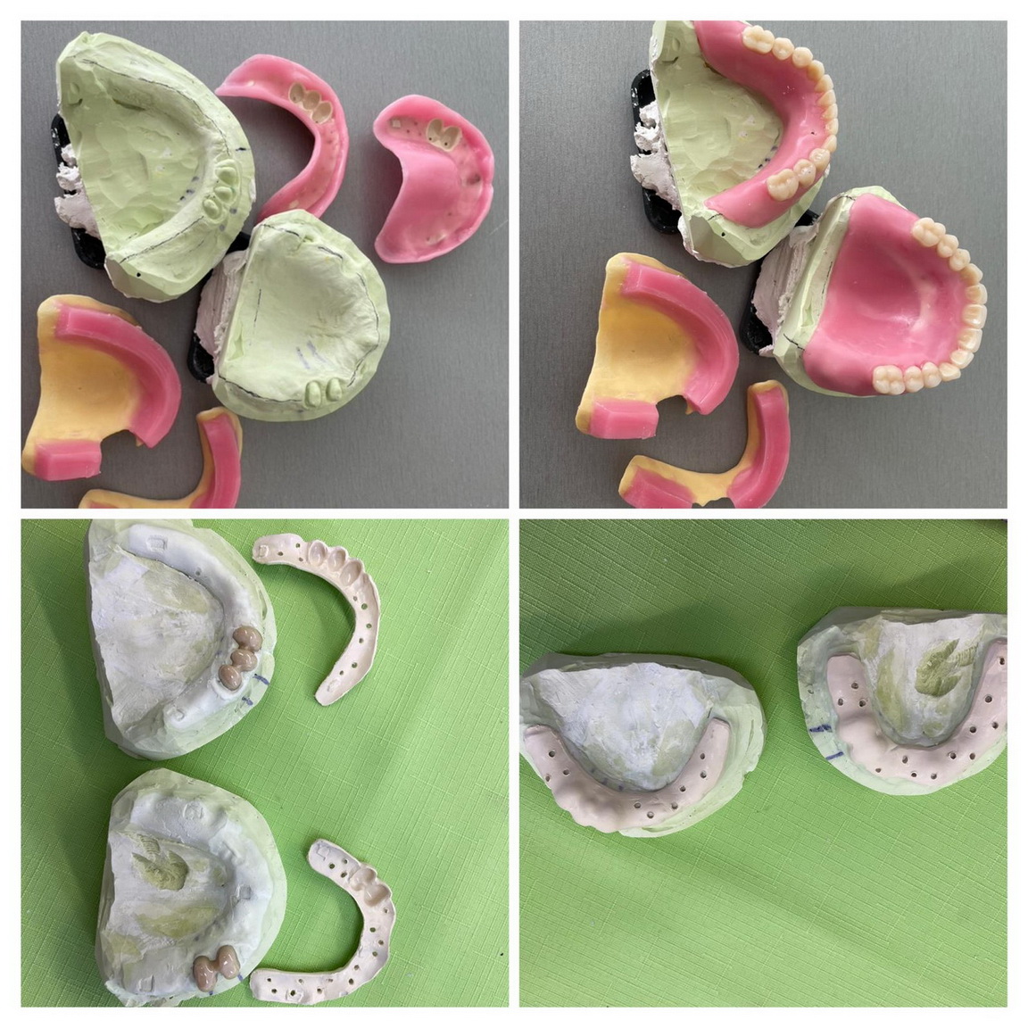 Teleskopická náhrada / Teleskopická práce