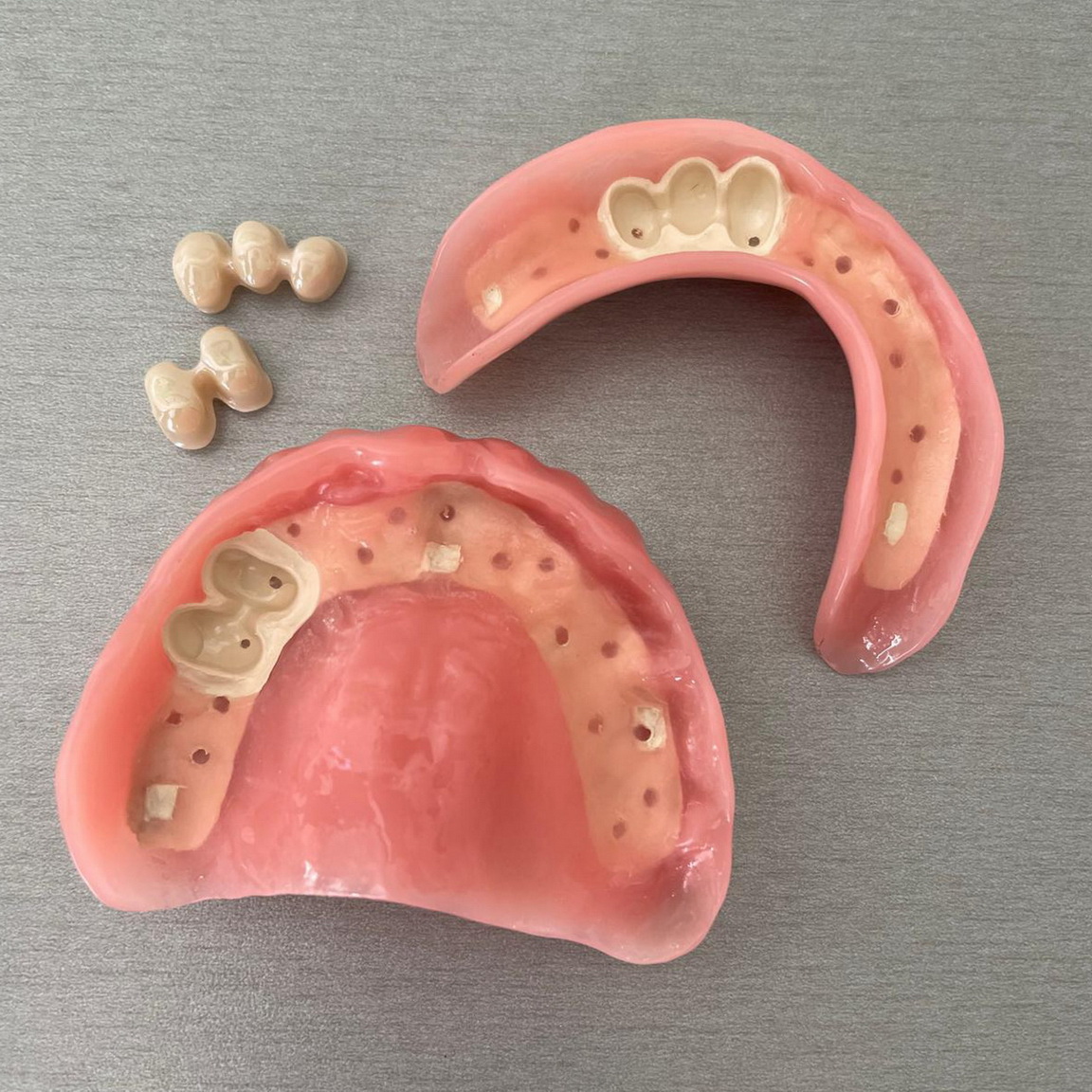 Teleskopická náhrada / Teleskopická práce