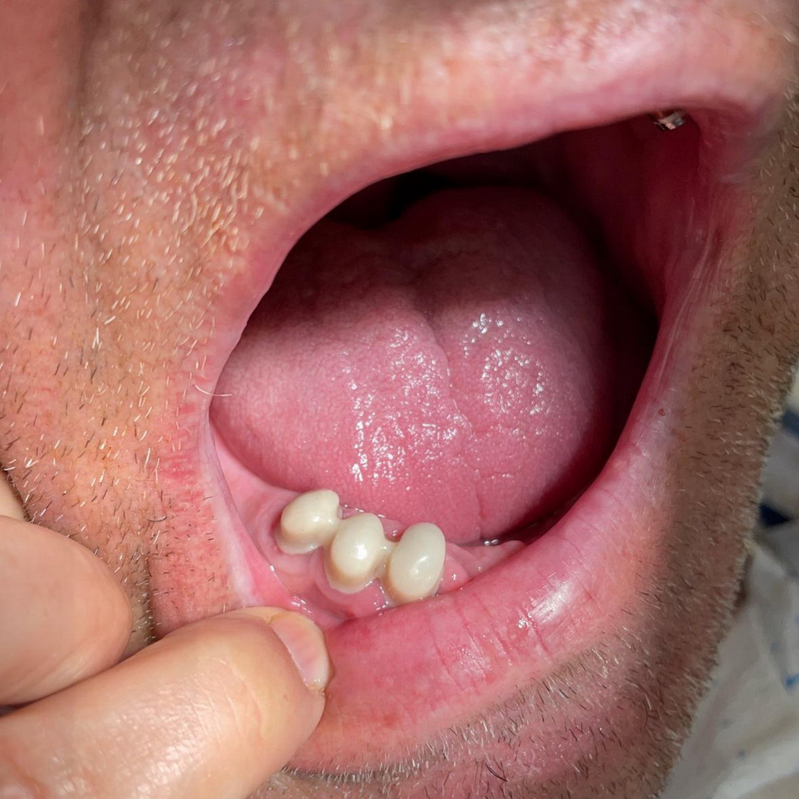 Teleskopická náhrada / Teleskopická práce