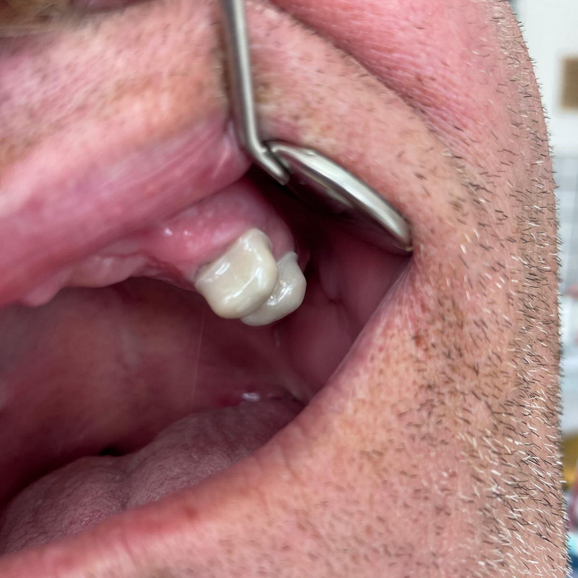 Teleskopická náhrada / Teleskopická práce