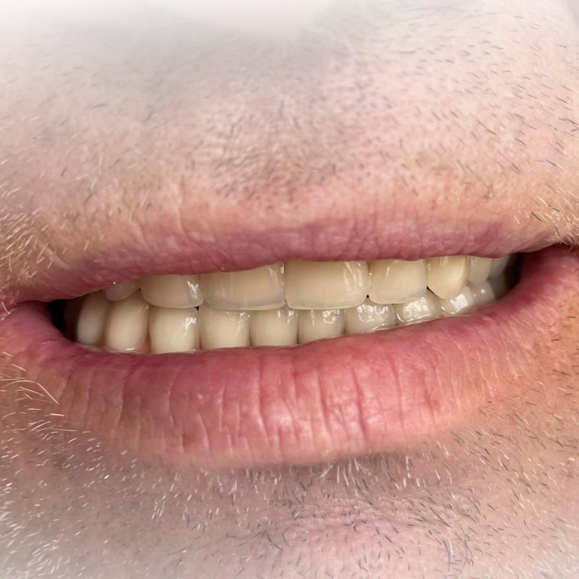 Teleskopická náhrada / Teleskopická práce